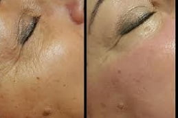 PRP Facial Treatment in Islamabad