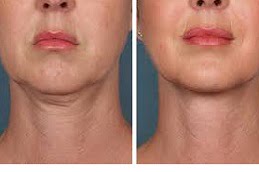 PRP Treatment in Islamabad