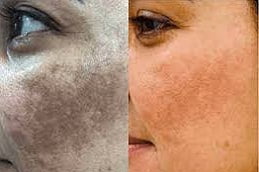 Pigmentation Treatment Clinic in Islamabad, Pakistan