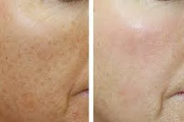 Pigmentation Treatment Clinic in Islamabad