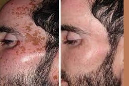Pigmentation Treatment in Islamabad