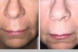 Pigmentation Treatment in Islamabad,Pakistan