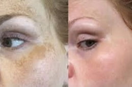 Skin Pigmentation in Islamabad