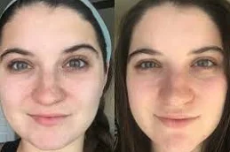 Skin Whitening Treatment Clinic in Islamabad, Pakistan