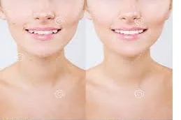 Skin Whitening Treatment in Islamabad