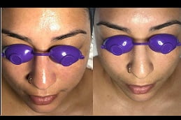 Hydrafacial Treatment Clinic in Islamabad