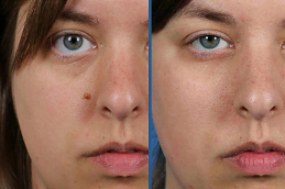 Best Mole Removal treatment Clinic in Islamabad & Rawalpindi