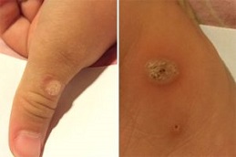 Best Warts Removal Treatment Clinic in Islamabad
