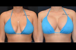 Best breast-implants Clinic in Islamabad
