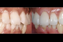 Best crooked teeth treatment Clinic in Islamabad