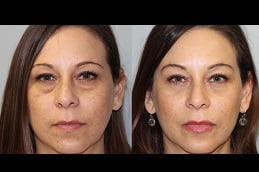 Best eye-bag-removal Clinic in Islamabad