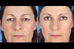 Best eye-bag-removal in Rawalpindi