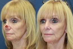 Best facial-scar-revision in Rawalpindi