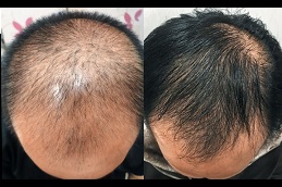 Best hair fillers for baldness in Rawalpindi
