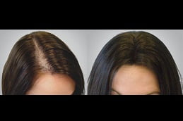 Best hair-loss-treatment Clinic in Islamabad