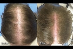 Best hair-loss-treatment in Rawalpindi