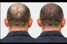 Best hair-transplant Clinic in Islamabad
