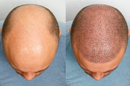 Best hair-transplant in Rawalpindi