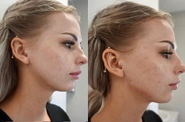 Best jawline-fillers-injections in Rawalpindi