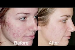 Best laser-acne-treatment Clinic in Islamabad