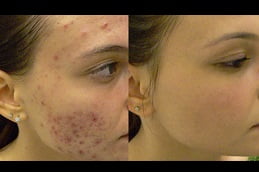 Best laser-acne-treatment in Rawalpindi