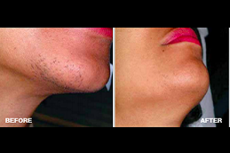 Best laser hair removal for men and women in Rawalpindi