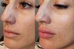 Best lip fillers Clinic in Islamabad