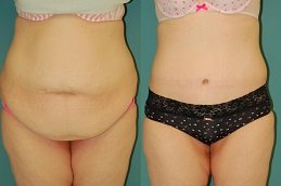 Best liposuction in Rawalpindi