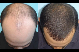 Best mesotherapy-for-hair-loss Clinic in Islamabad