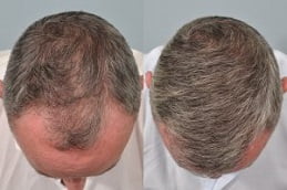 Best mesotherapy-for-hair-loss in Rawalpindi