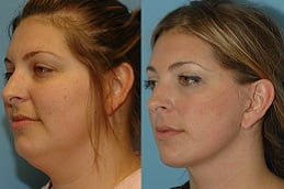 Best neck-lift Clinic in Islamabad
