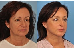 Best neck-lift in Rawalpindi