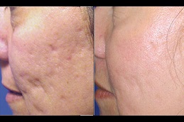 Best radio frequency for acne scars in Rawalpindi