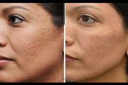 Best subcision treatment for acne scars in Saudi Arabia