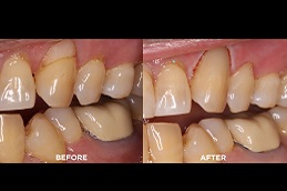 Best teeth filling price Clinic in Islamabad