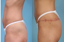 Best thigh-lift-treatment Clinic in Islamabad
