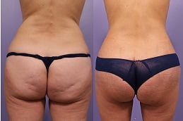 Best thigh-lift-treatment in Rawalpindi
