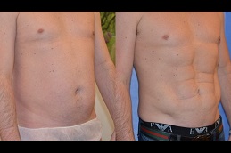 Best vaser-4d-liposuction Clinic in Islamabad