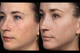 Dermapen Treatment Clinic in Islamabad