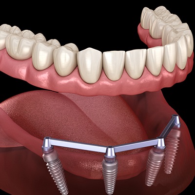 Full Mouth Dental Implants Cost in Islamabad