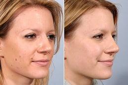 Mole Removal treatment Clinic in Islamabad & Rawalpindi