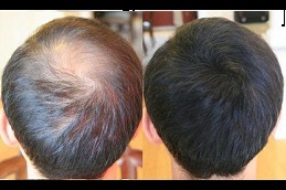 alopecia areata treatment in rawalpindi