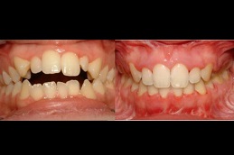 best crooked teeth treatment in ISLAMABAD