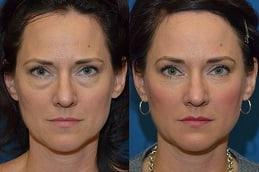 best eye-bag-removal in ISLAMABAD