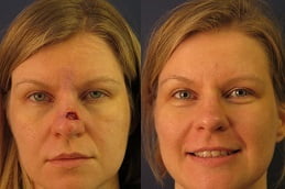 best facial-scar-revision in ISLAMABAD