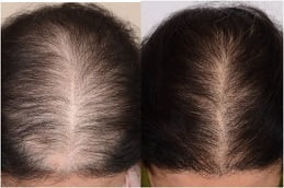best hair-loss-treatment in ISLAMABAD