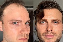 best hair-transplant in ISLAMABAD