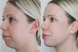 best jawline-fillers-injections in ISLAMABAD