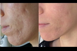best laser-acne-treatment in ISLAMABAD