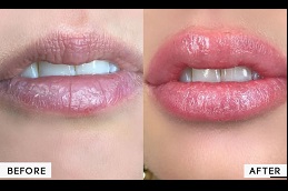 best lip pigmentation treatment in ISLAMABAD